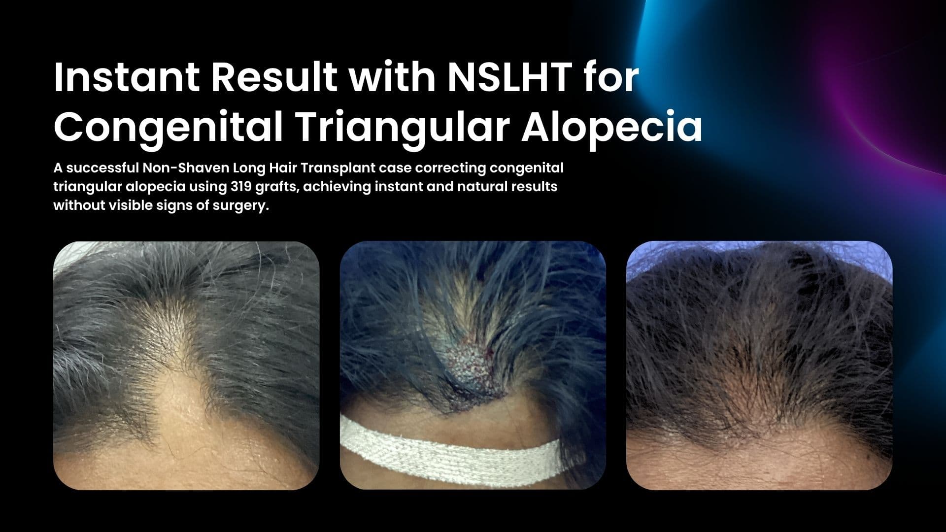 Female patient showing instant transformation after Non-Shaven Long Hair Transplant (NSLHT) at Trichos Hyderabad.