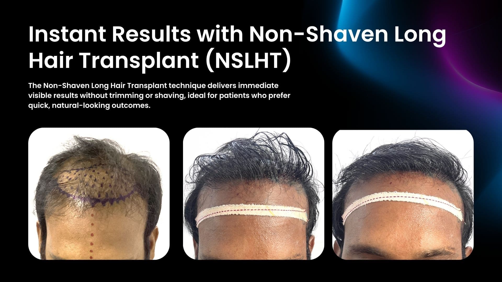 Instant visible result after Non-Shaven Long Hair Transplant (NSLHT) at Trichos Hyderabad β no trim, natural finish.