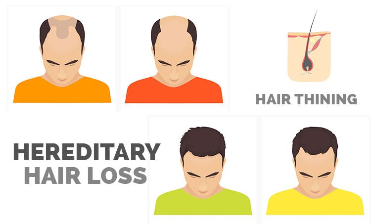 Best Hair Clinic in Hyderabad For Androgenic Alopecia
