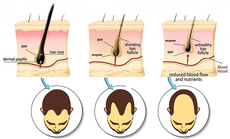 Understanding DHT's Impact on Hair Loss