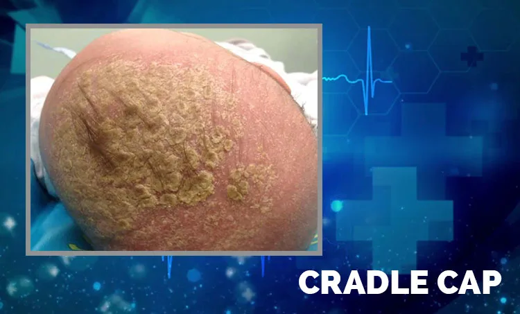 CRADLE CAP