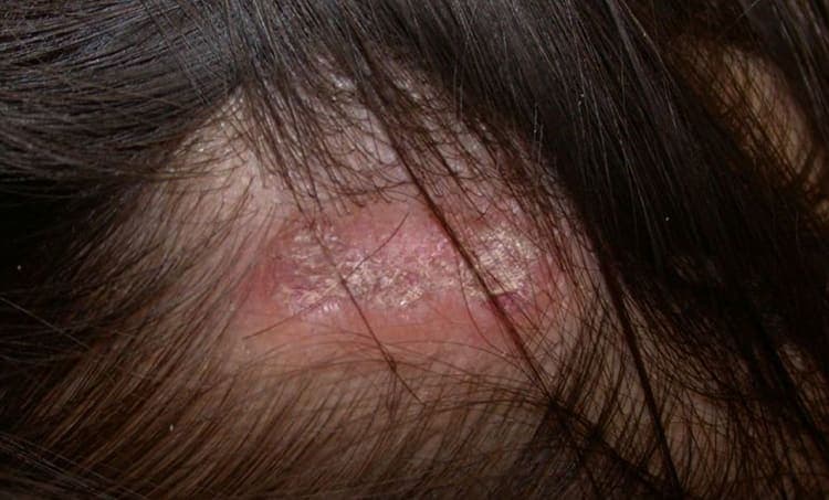 Discoid Lupus Erythematosus