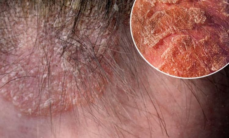 Eczema