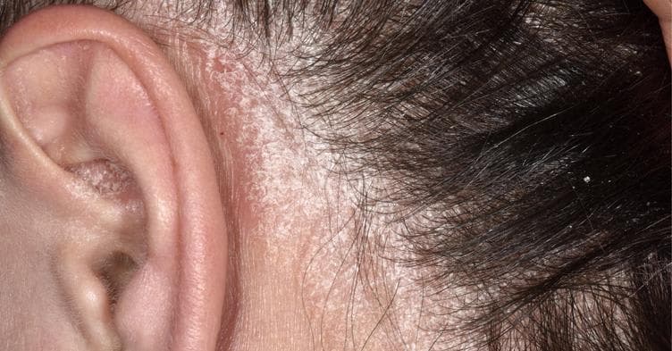 Scalp Psoriasis