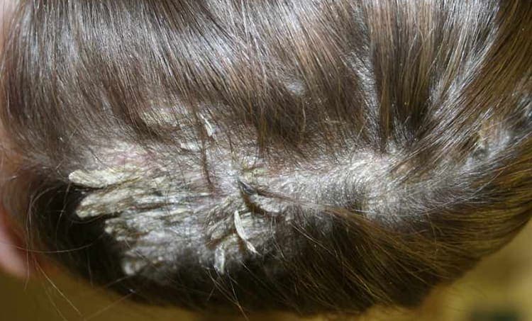 Pityriasis Amiantacea