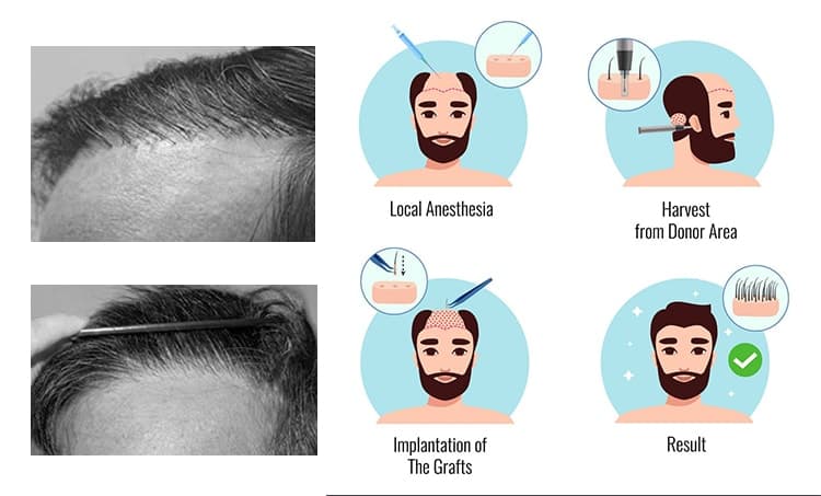 Corrective Hair Restoration