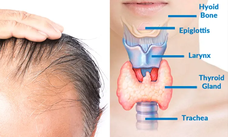 Thyriod Hair Loss