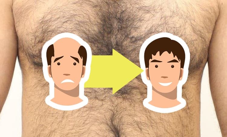 Body Hair Transplant