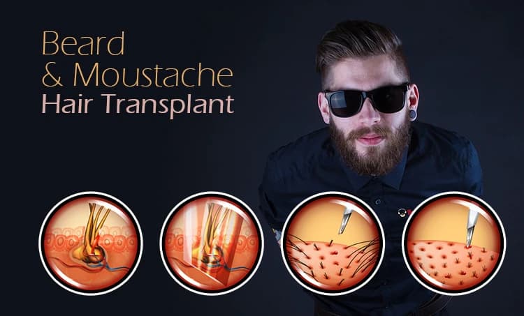 Beard & Moustache Hair Transplant