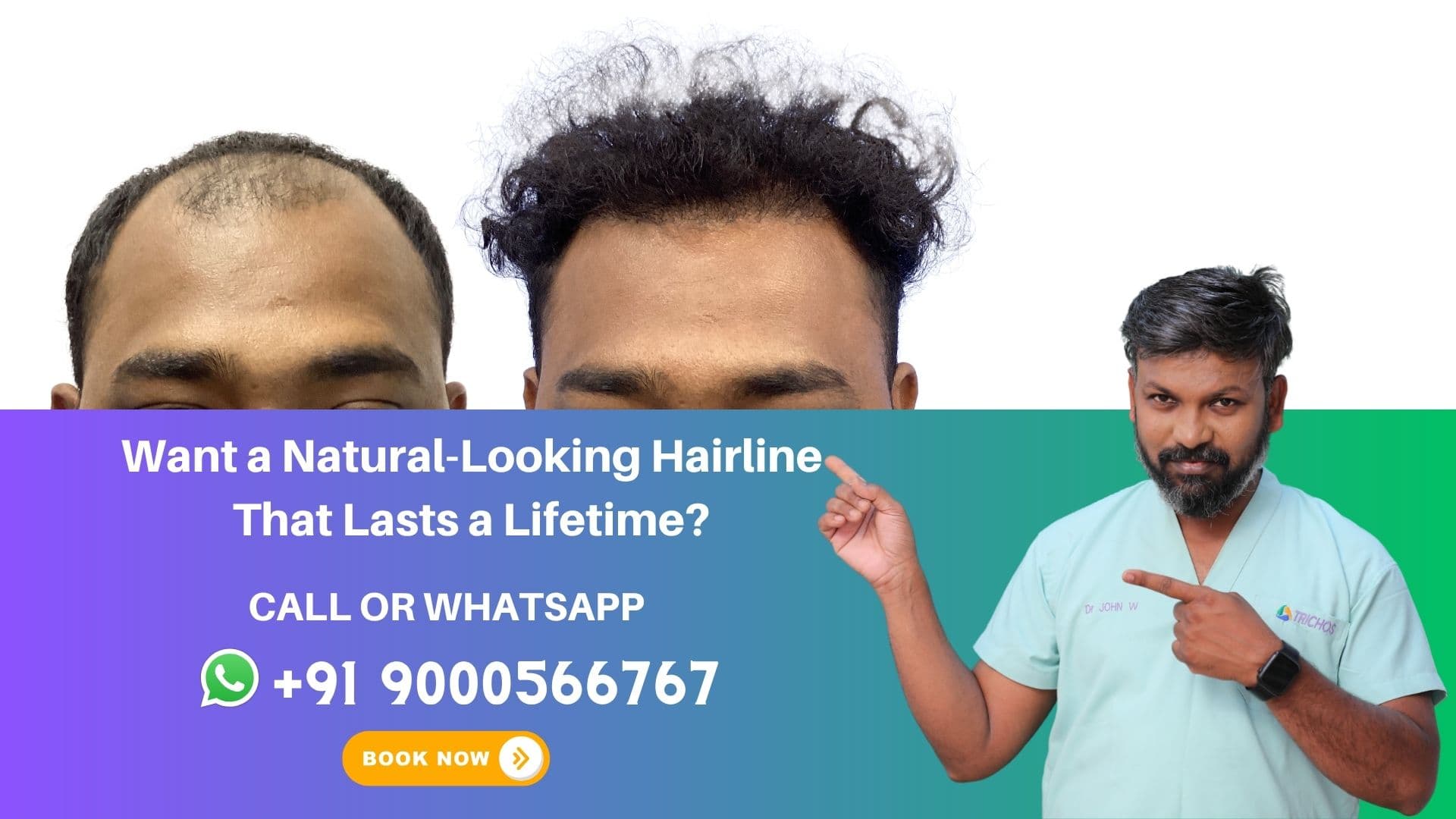 Before and after transformation of a patient undergoing advanced FUE hair restoration treatment for baldness in Hyderabad at Trichos.